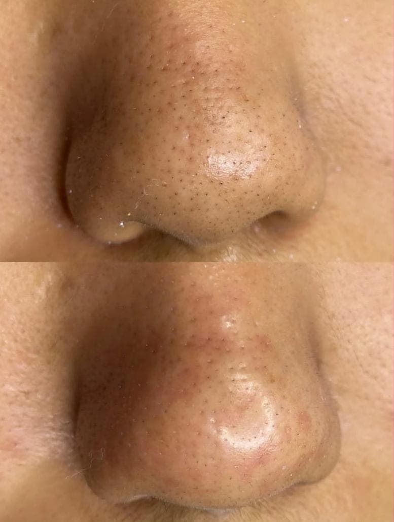 Resultados antes e depois 1