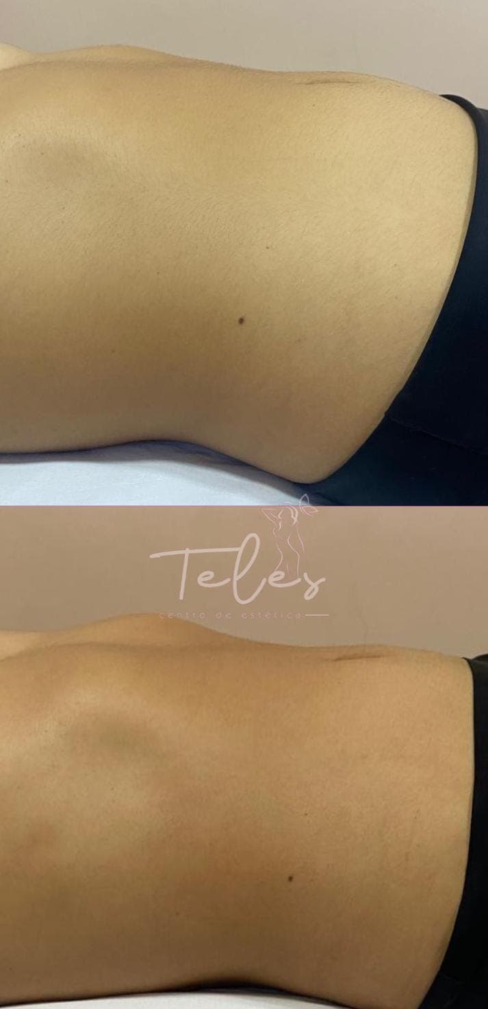 Resultados antes e depois 2