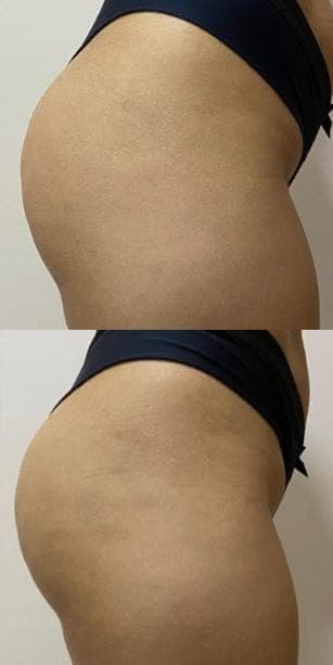 Resultados antes e depois 5